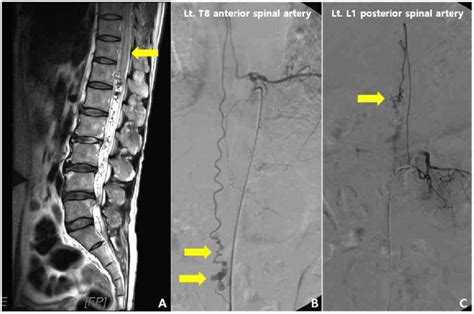 Lumbar Spine Magnetic Resonance Imaging And Spinal Angiography Lumbar