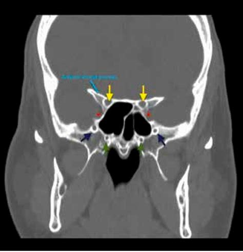 Figure 1 From Challenges Of Endoscopic Approach In Sphenoid Sinus Surgery For Beginners