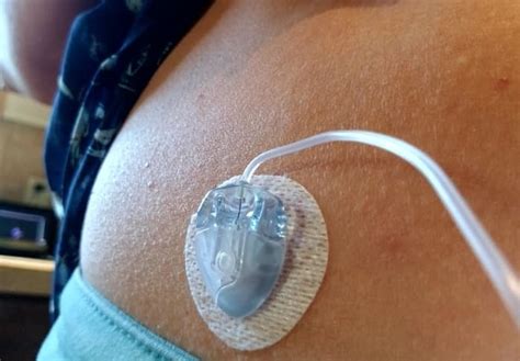 Insulin Pumps—pros And Cons Hubpages