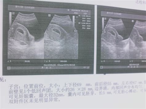 怀孕50天b超图显示如下，孕囊一般是三个数据，至少也两个，为何该医院只给出一个？ 百度宝宝知道