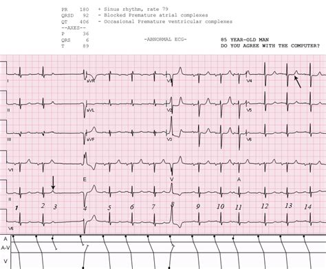 Sinus Rhythm With Ectopy | ECG Guru - Instructor Resources