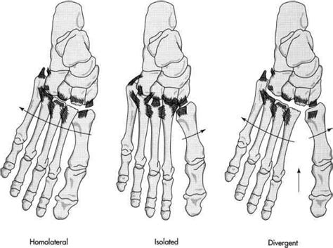 Lisfranc Injury Houston Sports Injury Treatment Tanglewood Foot