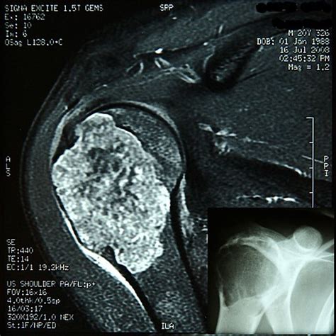 Chondrosarcoma Mri