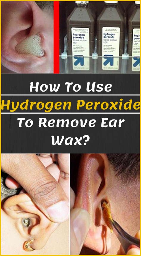 How To Clean Your Ears With Water And Peroxide At Sylvia Baxter Blog