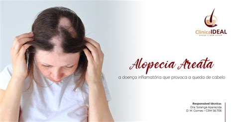 Alopecia areata doença inflamatória que provoca queda de cabelo