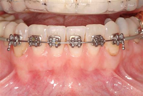 Retention And Orthodontic Treatment Pankeygram