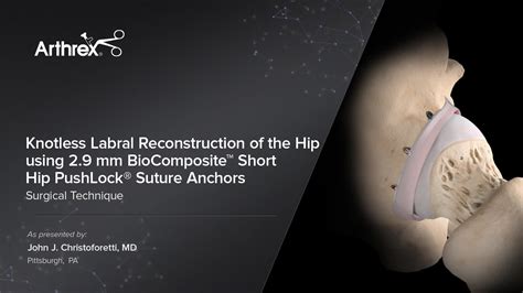 Arthrex Knotless Labral Reconstruction Of The Hip Using 2 9 Mm