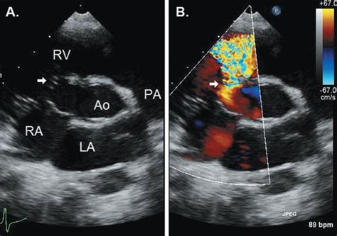 Ventricular Septal Defects Thoracic Key