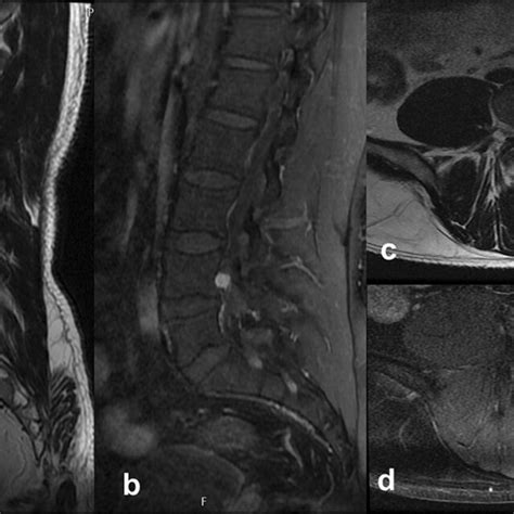 Case 1. Spinal MRI demonstrated a small regular mass at right L4–5 ...