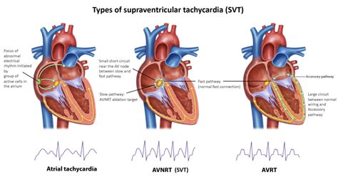 Supraventricular Tachycardia Svt Melbourne Heart Group