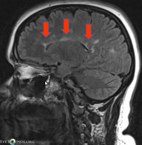 Neuritis: Mri Optic Neuritis