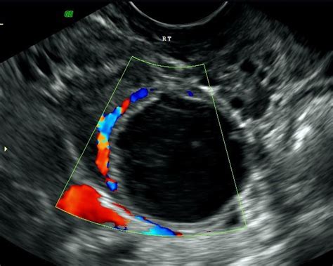 Pelvic Ultrasound Scan