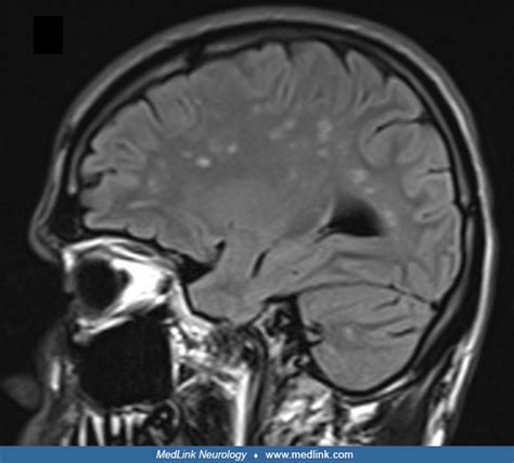 Susac Syndrome Medlink Neurology