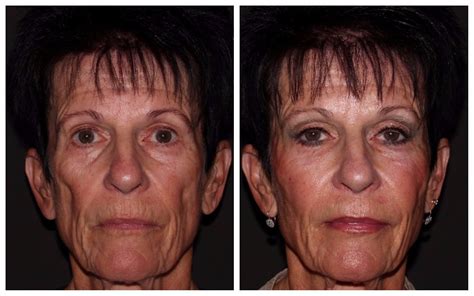 Fat Transfer Grafting Dermal Filler Broomfield Denver