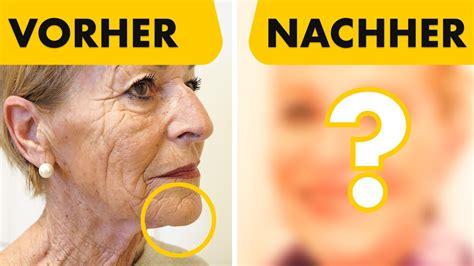 Facelift In Op Mit Jahren Vorher Nachher Vergleich Dr