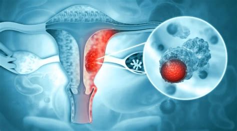 Uterus Cancer Symptoms Diagnosis And Treatment Kkr Hospital