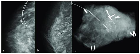 Wire Guided Localization Craniocaudal A And Mediolateral B Oblique