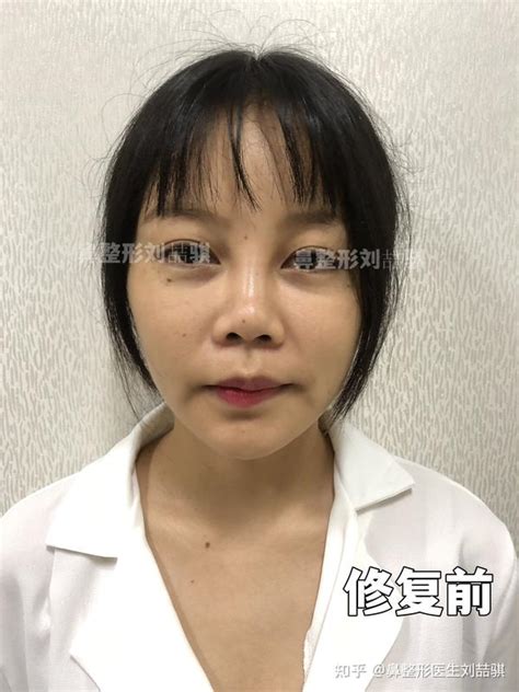 鼻修复案例拯救被线雕做坏了的鼻子 知乎