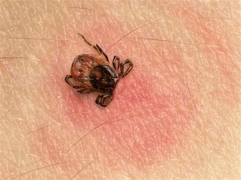 Malattia Di Lyme Diagnosi Cura Prevenzione