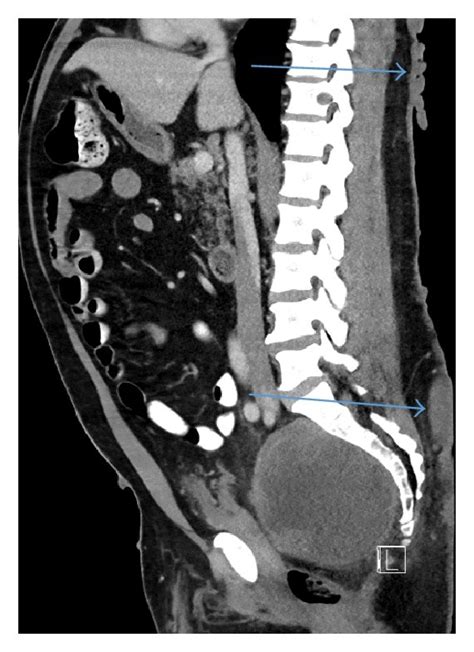 A Coronal Ct Shows Heterogeneous Pelvic Mass And A Left Hip