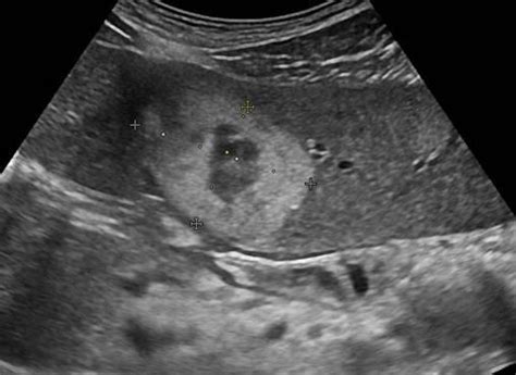 Abdomen And Retroperitoneum 1 1 Liver Case 1 1 1 Focal Nodular