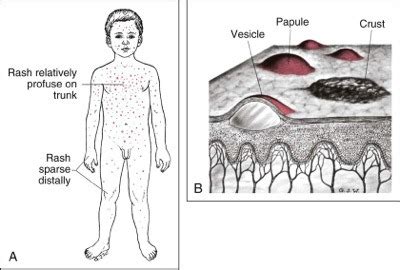 Chicken Pox Shingles Case Study Flashcards Quizlet