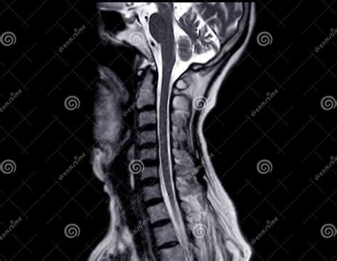 Mri Of C Spine Or Magnetic Resonance Image Of Cervical Spine Sagittal View For Diagnosis