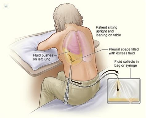 Hemothorax Pleural Effusion Pneumothorax Tension Pneumothorax