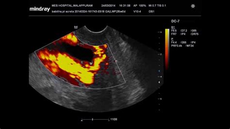 Placenta Percreta Dopplerdrvahabkp Youtube