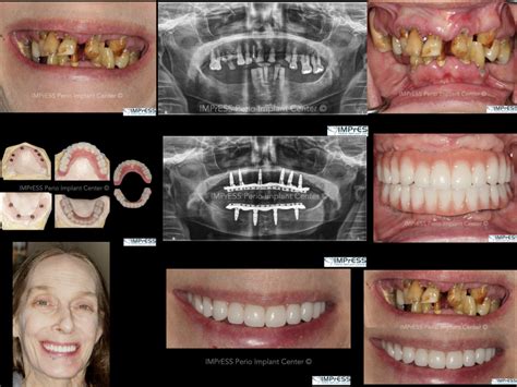 All On X Implant Full Mouth Implant Reconstruction All On Implants