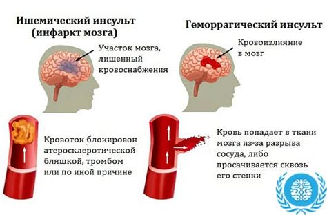 Инфаркт мозга — Предупреждение и эффективные методы лечения, советы врачей