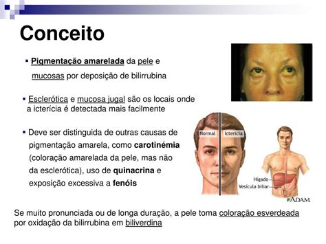 Itiacao Na Pele Autoimune Icterícia - PPT - Icterícia PowerPoint Presentation, free download - ID:3306313