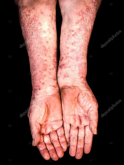 Manos con psoriasis fotografía de stock uroszunic 83445286