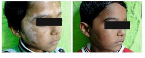 Childhood Vitiligo By Dr. Bhavesh Devani