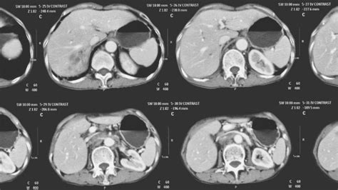 First Treatment Approved In England For Advanced Bile Duct Cancer