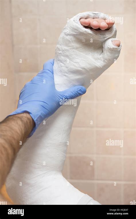 Thumb Spica Cast Hi Res Stock Photography And Images Alamy