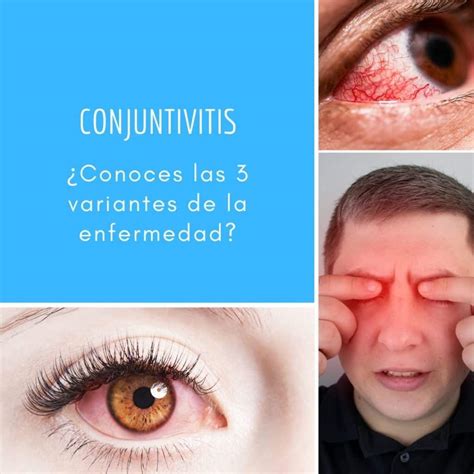 Conjuntivitis Conoces Las Variantes De La Enfermedad