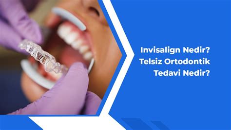 Invisalign Nedir Telsiz Ortodontik Tedavi Nedir Youtube