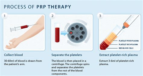 Platelet Rich Plasma Treatment Prp For Acne Premier Clinic Cn