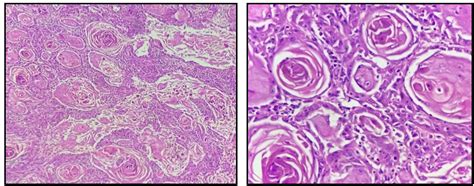 Histomorphological Variants Of Oral Squamous Cell Carcinoma And Their