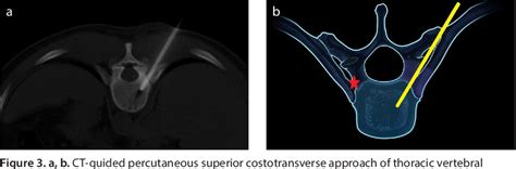 Figure 3 From Approach Based Techniques Of Ct Guided Percutaneous