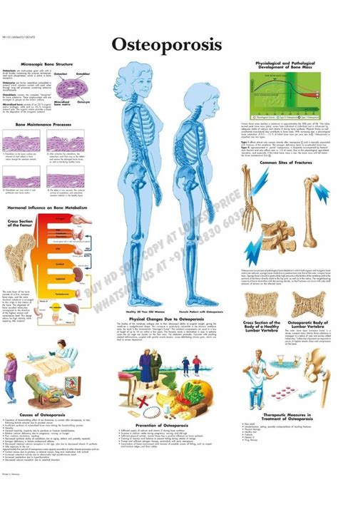 Osteoporosis Chart | Special education visual, Special education schedule, Special education ...