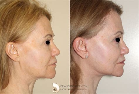 Mini Facelift Before And After