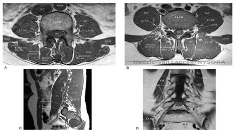 Lumbar Paravertebral Sonography And Considerations For Ultrasound