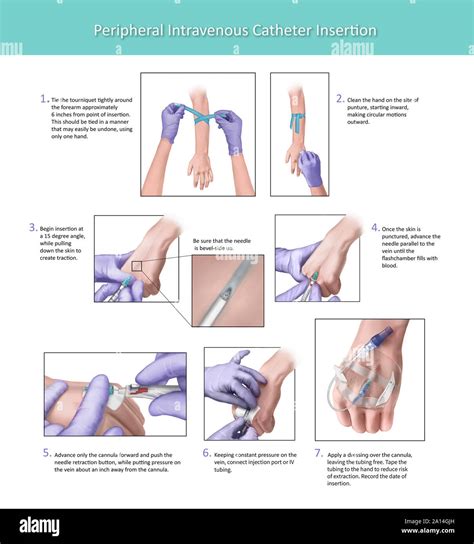 Site Of Intravenous Catheter Insertion And Blood Draws