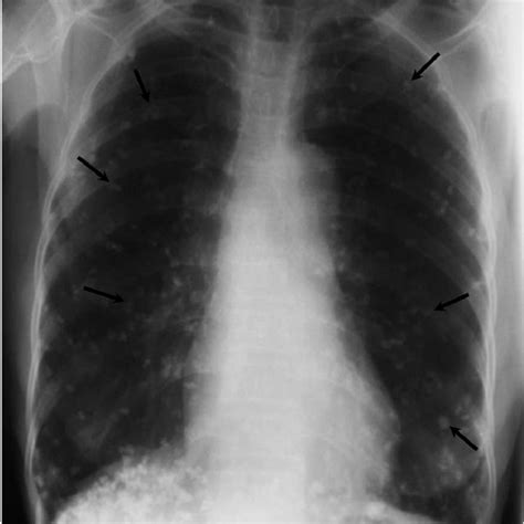 Postero Anterior Chest Radiograph Showing Numerous Curvilinear Calcific