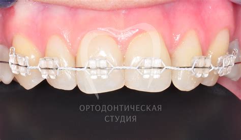 Элементы брекет-системы: ортодонтические кольца, дуга, лигатуры ...