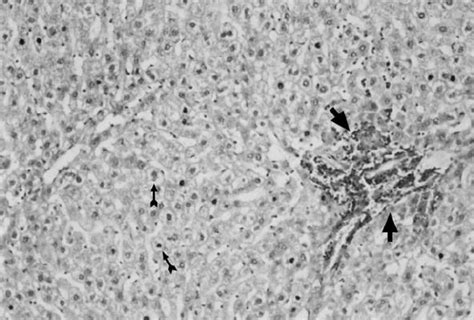 Md Ao Group Hydropic Degeneration In Hepatocytes Thin Short Arrows