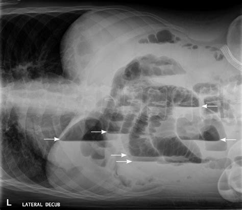 Lateral Decubitus View Of The Abdomen Showing Air Fluid Levels