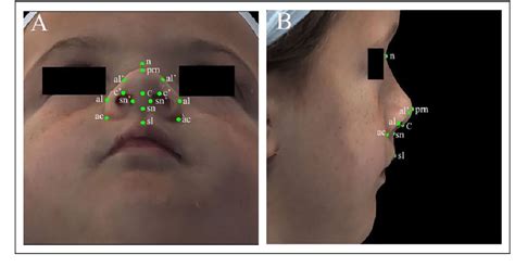 Figure 1 From Three Dimensional Analysis Of Bilateral Cleft Lip And Palate Nasal Deformity